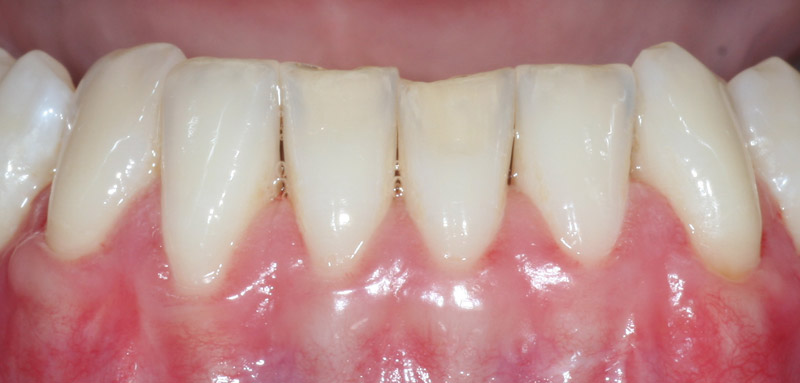 Artikel zu Zahnfleischrückgang