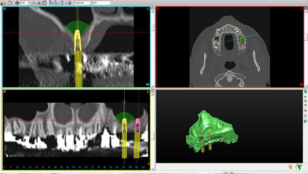 3D-Implantatplanung