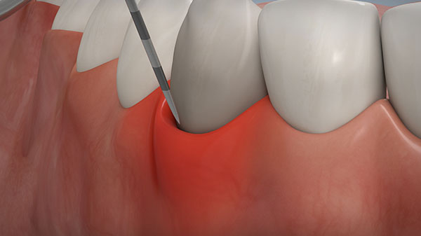 Zahnfleischrückgang: So läuft die Transplantation von Gaumengewebe ab