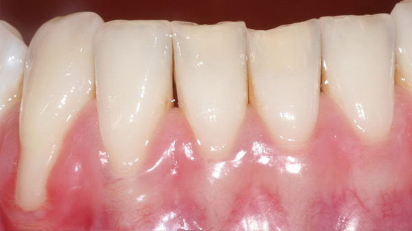 Zahnfleischrückgang