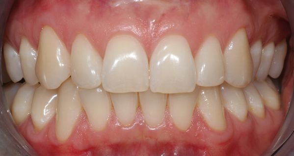 Zahnfleischästhetik