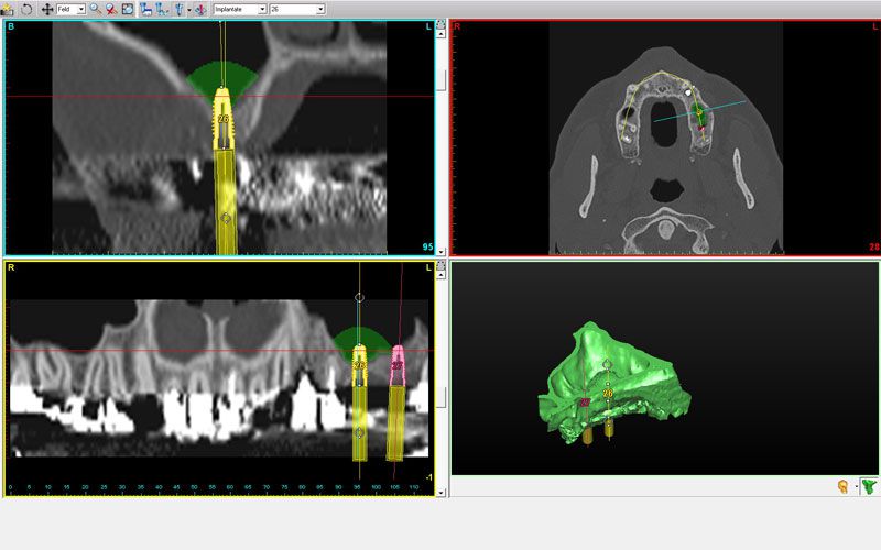 Implantate